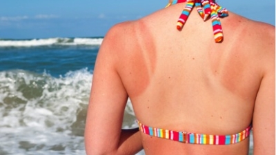 Arsurile solare: medicina ayurvedica te invata sa le previi, dar si sa le tratezi