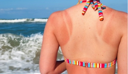 Arsurile solare: medicina ayurvedica te invata sa le previi, dar si sa le tratezi